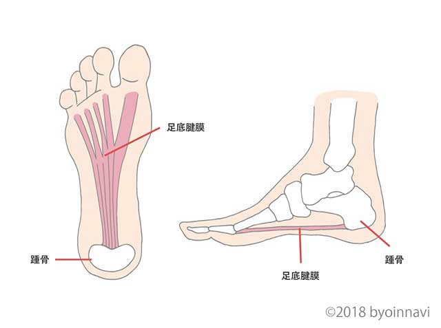 「足底筋膜炎」の画像検索結果