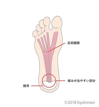 足底腱膜炎 足底筋膜炎 足の裏 かかとの痛みの原因 医師監修 体外衝撃波治療とは 病院なび