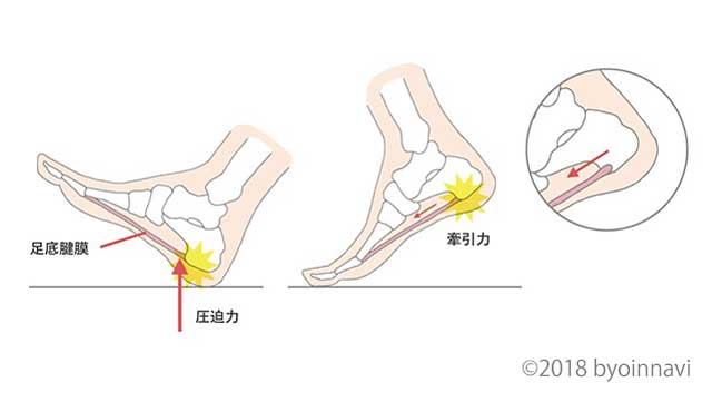 かかと が 痛い 左足 かかとが痛い…歩くと痛みが増す時は足底筋膜炎かも！？
